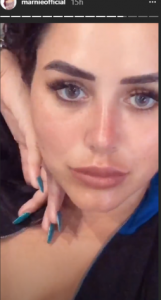 Marnie Simpson after nose job (Credit: Instagram)