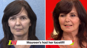 Maureen Nolan's facelift results 