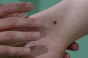 Lydia's mole is a cause for concern (Credit: ITV)