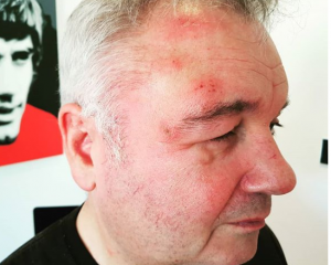 Eamonn Holmes with shingles (Credit: Instagram)