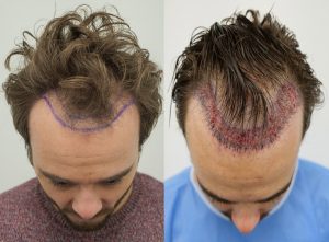 Jack P Shepherd undergoes hair transplant