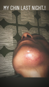 Melody Thornton suffers DOI injury