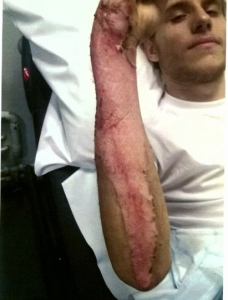 Alex burnt in hospital