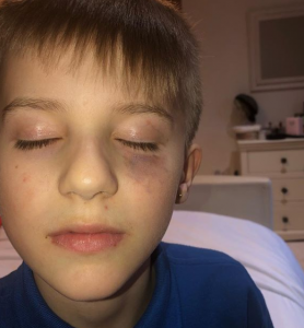 Kerry Katona's son gets beaten up