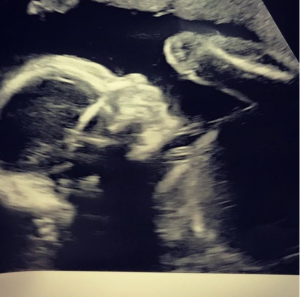 Emilie Cunliffe scan