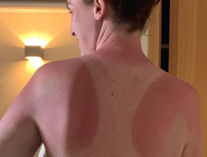 Vicky Pattison sunburn