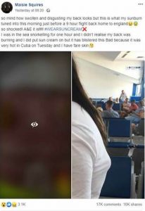 Maisie Squires sunburn