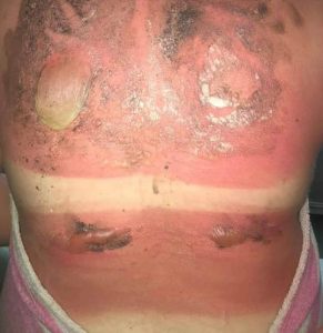 Maisie Squires sunburn