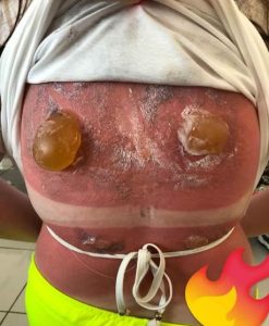 Maisie Squires sunburn