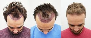 Jack had more than 3000 hairs implanted in the front of his scalp Crown Clinic