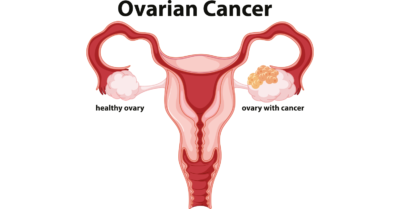 ovarian cancer graphic