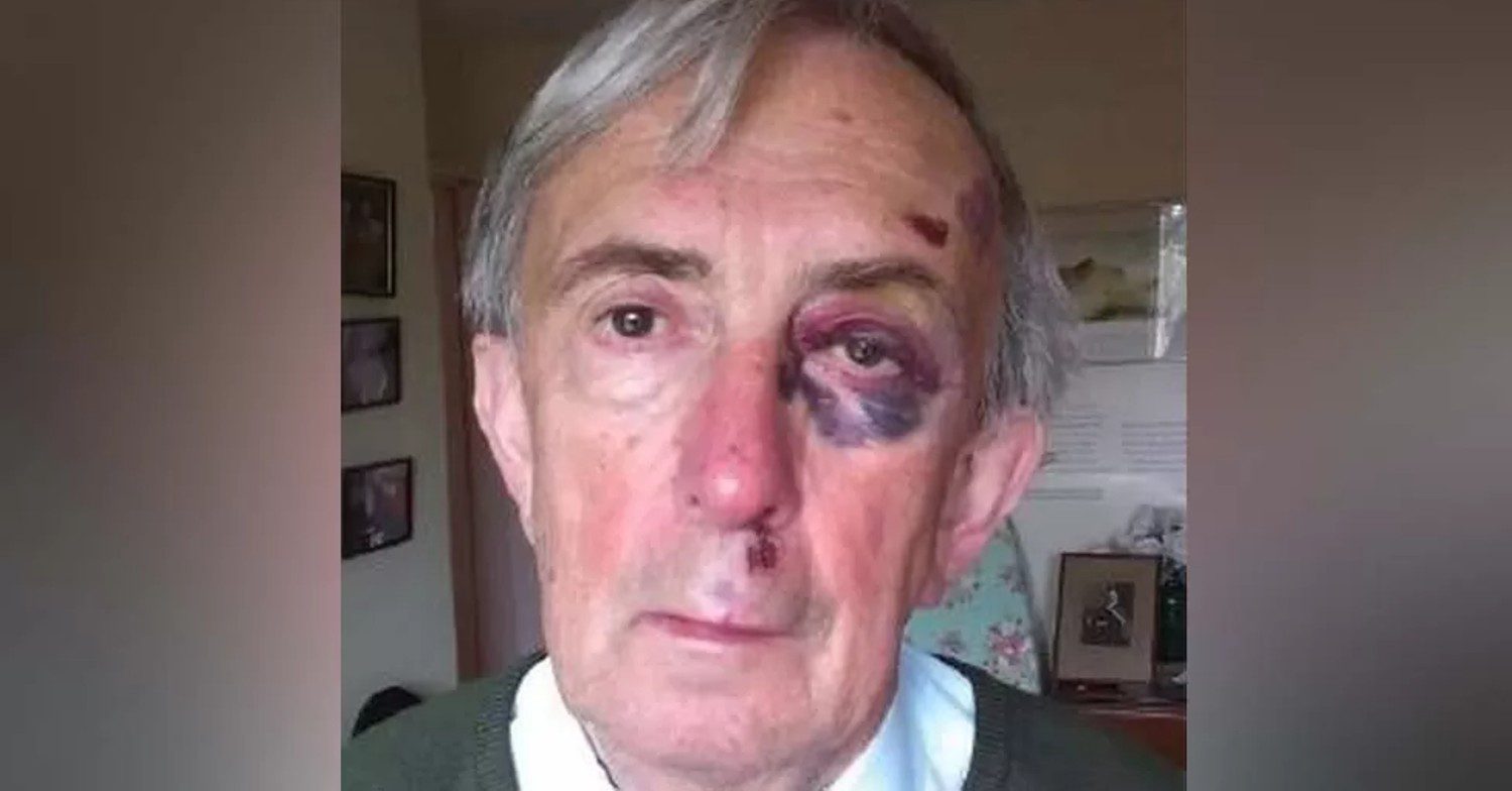 Peter Farquhar pictured with heavy bruising around the eyes