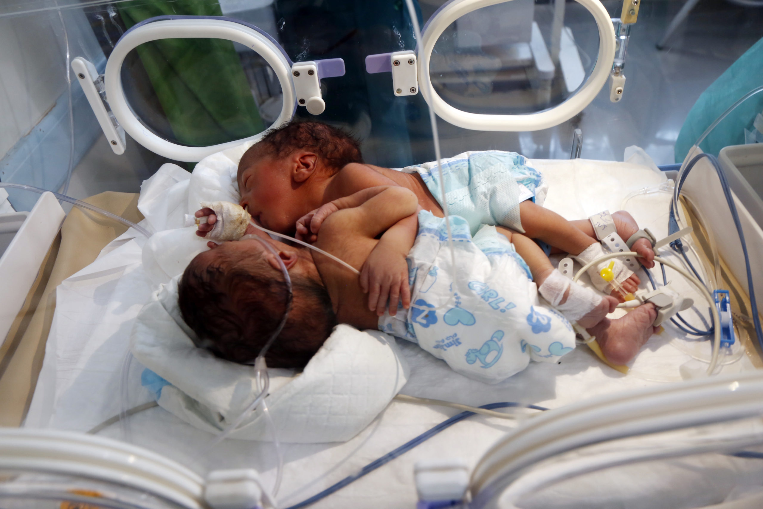 Yemen conjoined twins