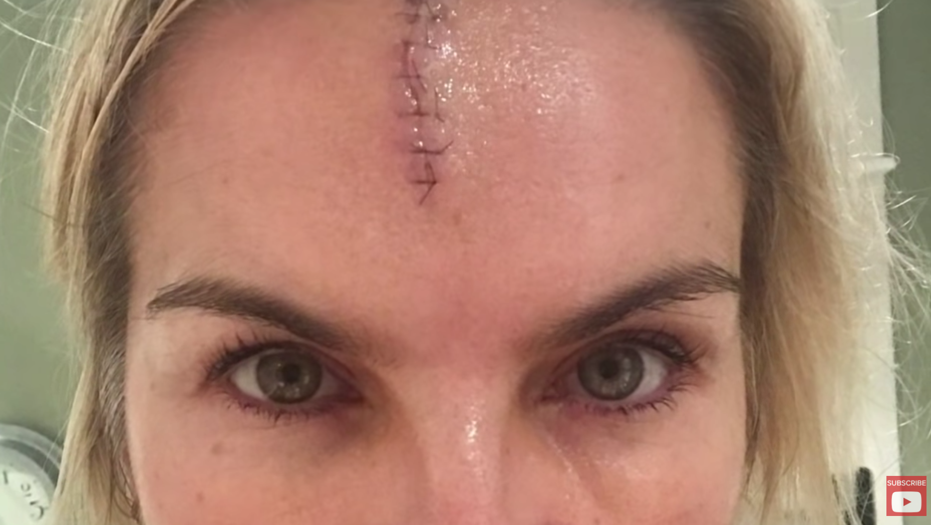 Katy Hill reveals she had a nasty head injury