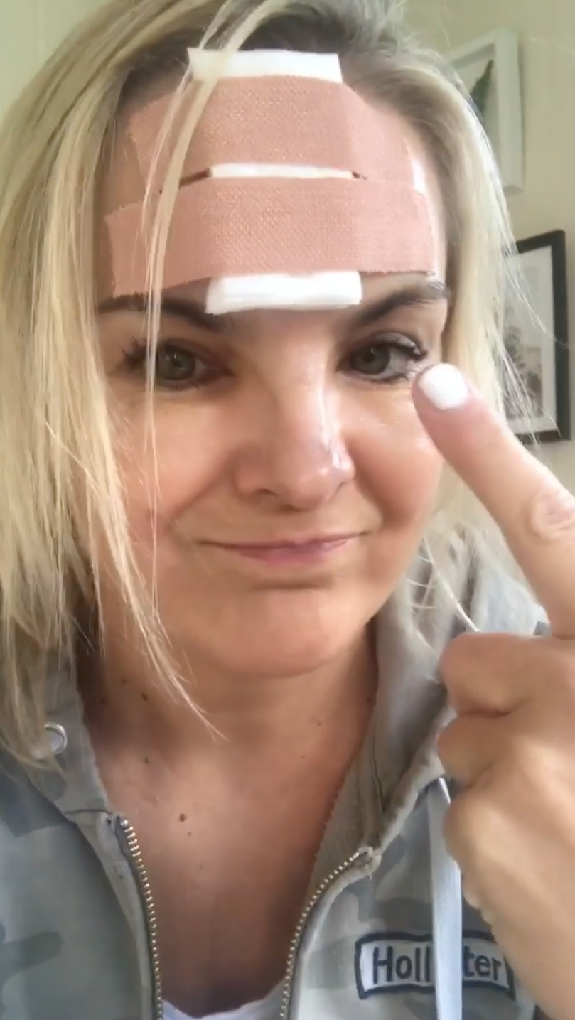 Katy Hill and her scar after the accident