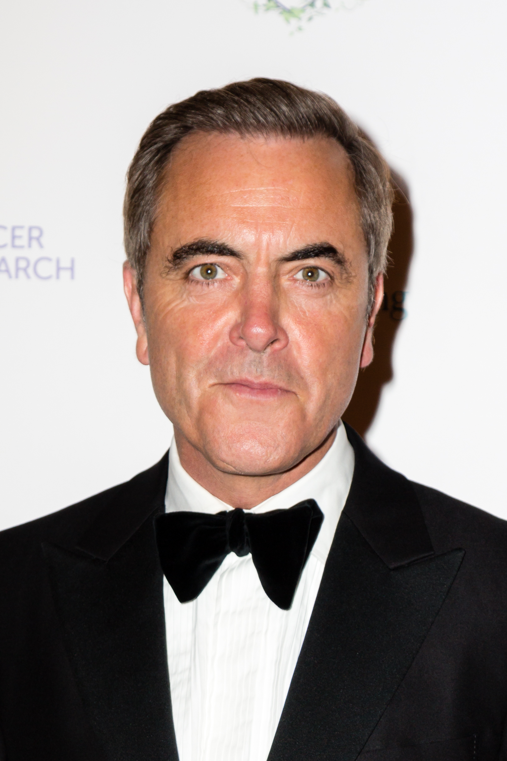 James Nesbitt had a hair transplant