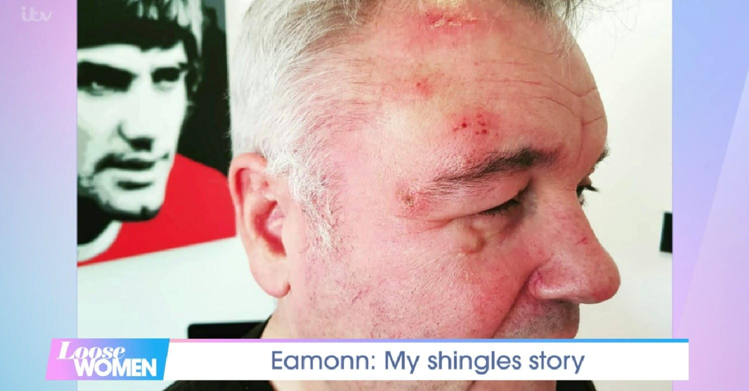 Eamonn Holmes health: star shows off shingles