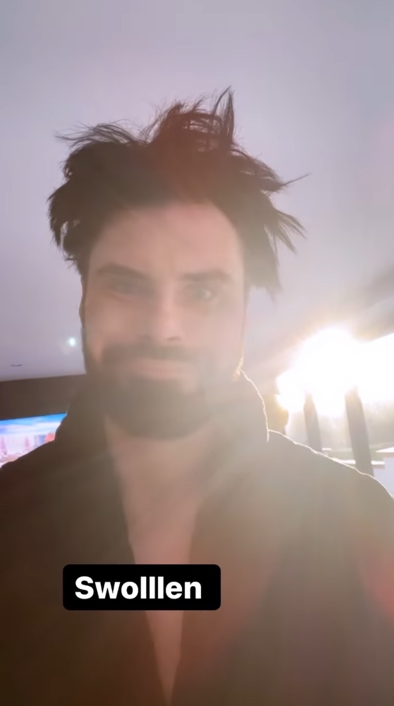 rylan clark new teeth