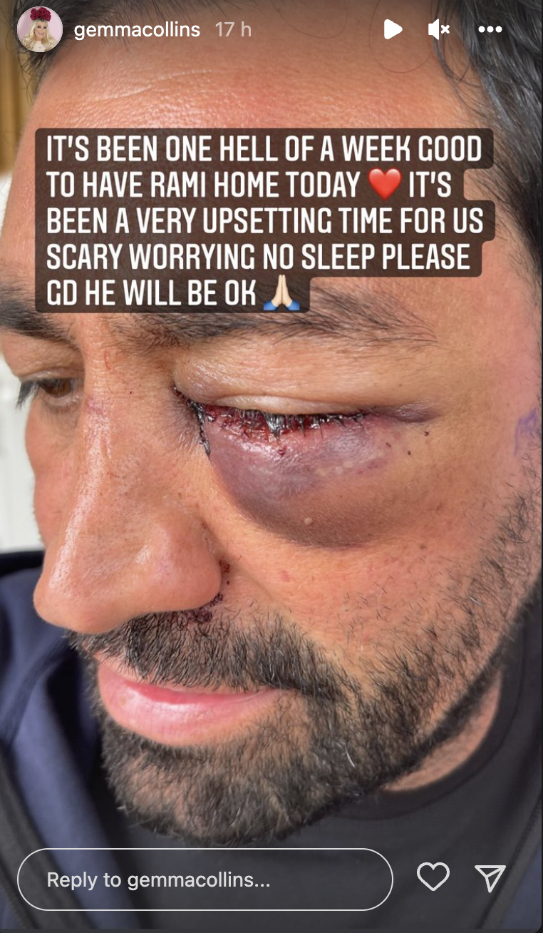 Gemma Collins fiance Rami has eye injury