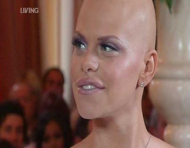 Jade Goody with no hair at her wedding
