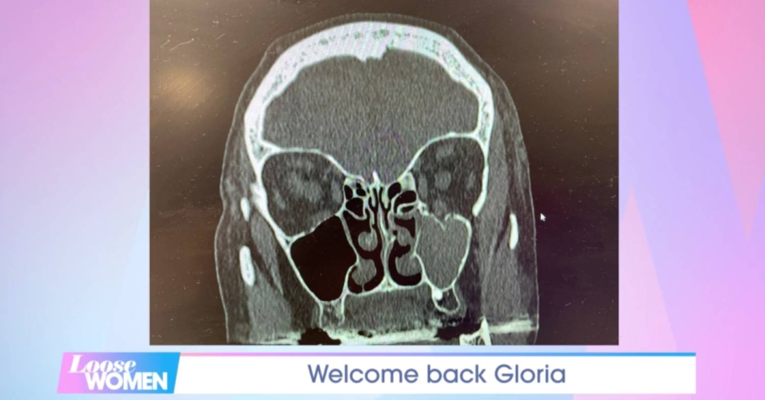 An X ray of Gloria Hunniford's face