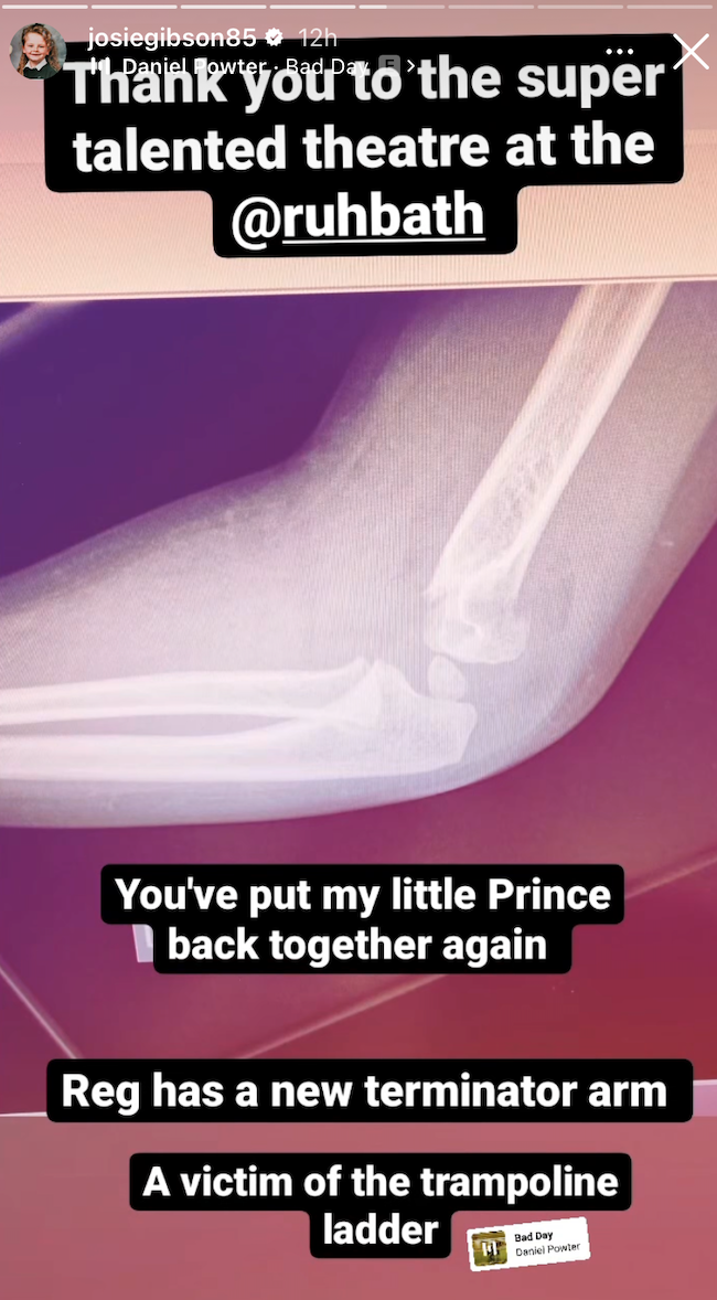 Josie Gibson shares son's X-ray