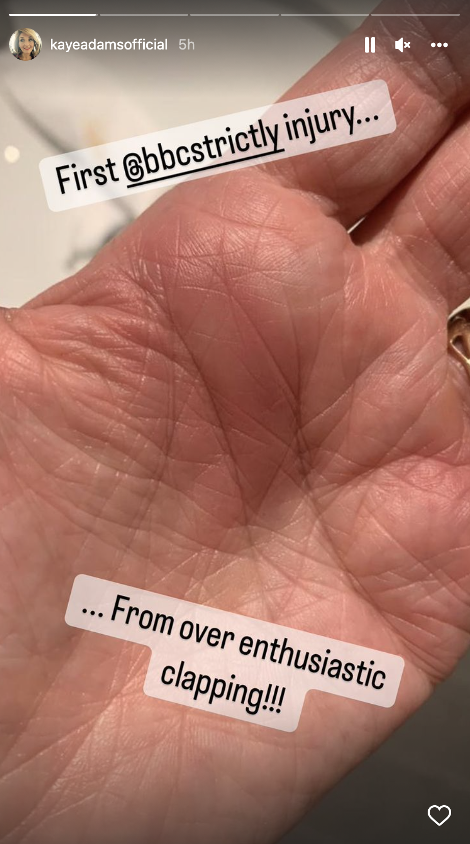 Strictly star Kaye Adams shows off injury on Instagram