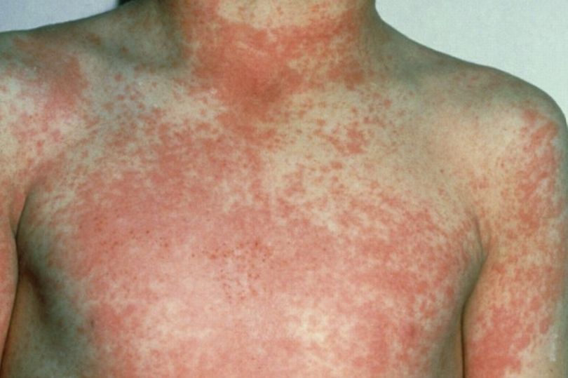 Child with Scarlet Fever rash on chest