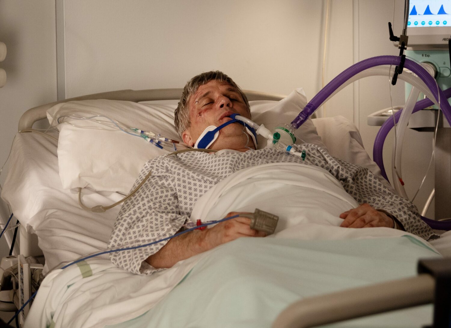 Emmerdale's Caleb is in a coma in a hospital bed with tube attached to him