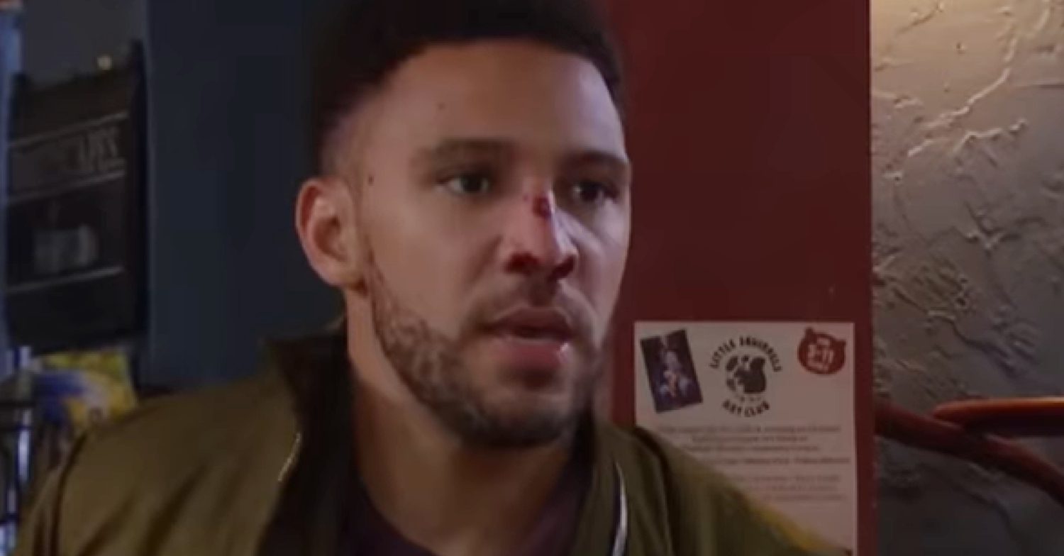 Emmerdale's Billy has a cut on his nose