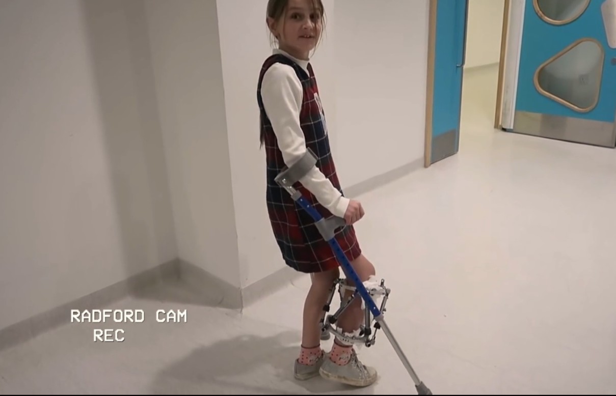 Tillie Radford leg on 22 Kids and Counting