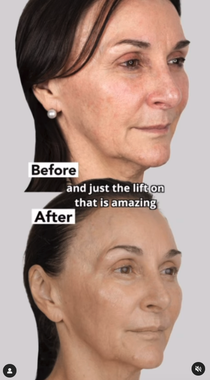 Before and after of Shirley Ballas and her non-surgical face lift