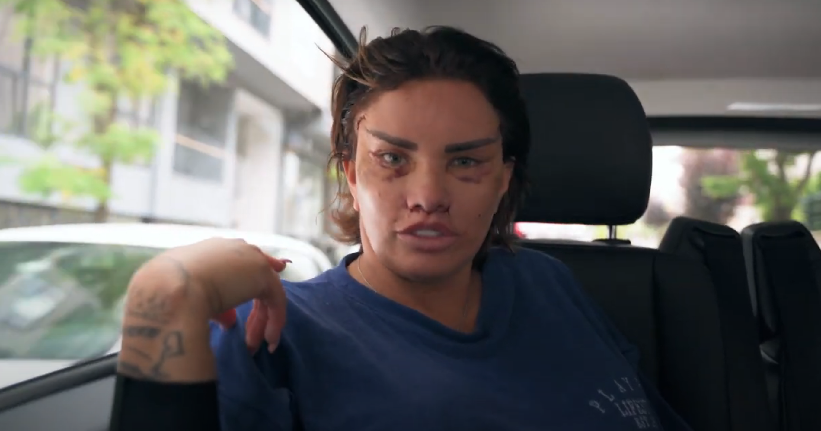 Katie Price facelift