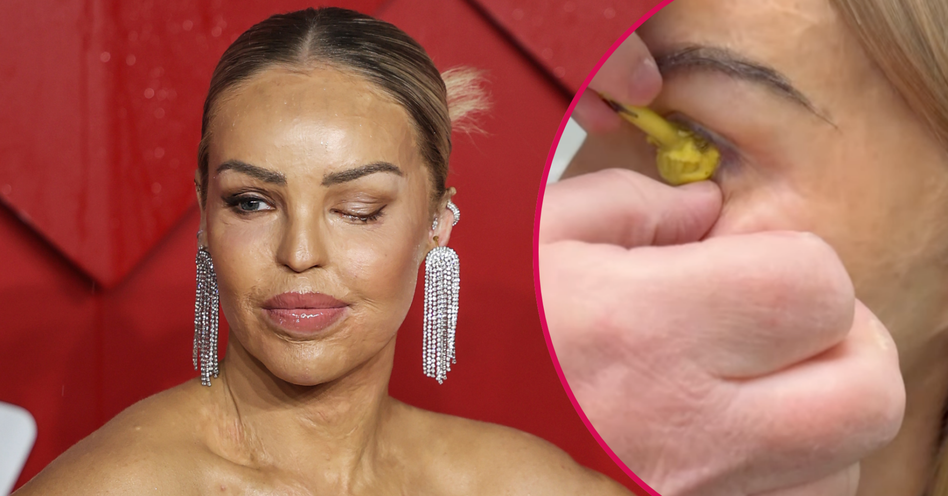 Katie Piper on the red carpet and having a prosthetic eye shell fitted