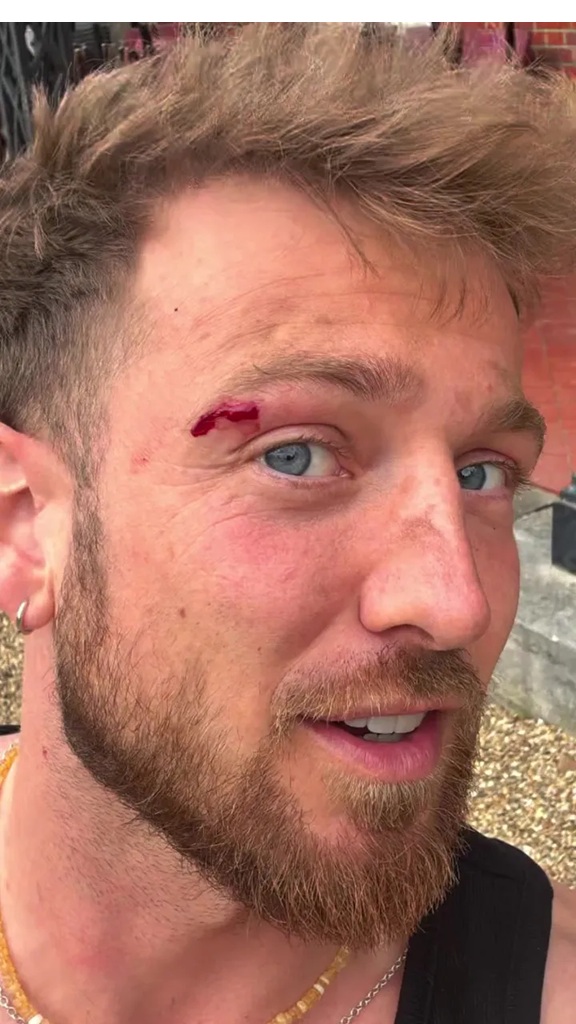 Sam Thompson and his bloody eyebrow