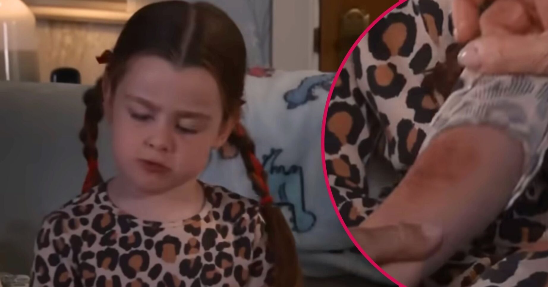 ED comp: Corrie Shanice / bruises on her arm