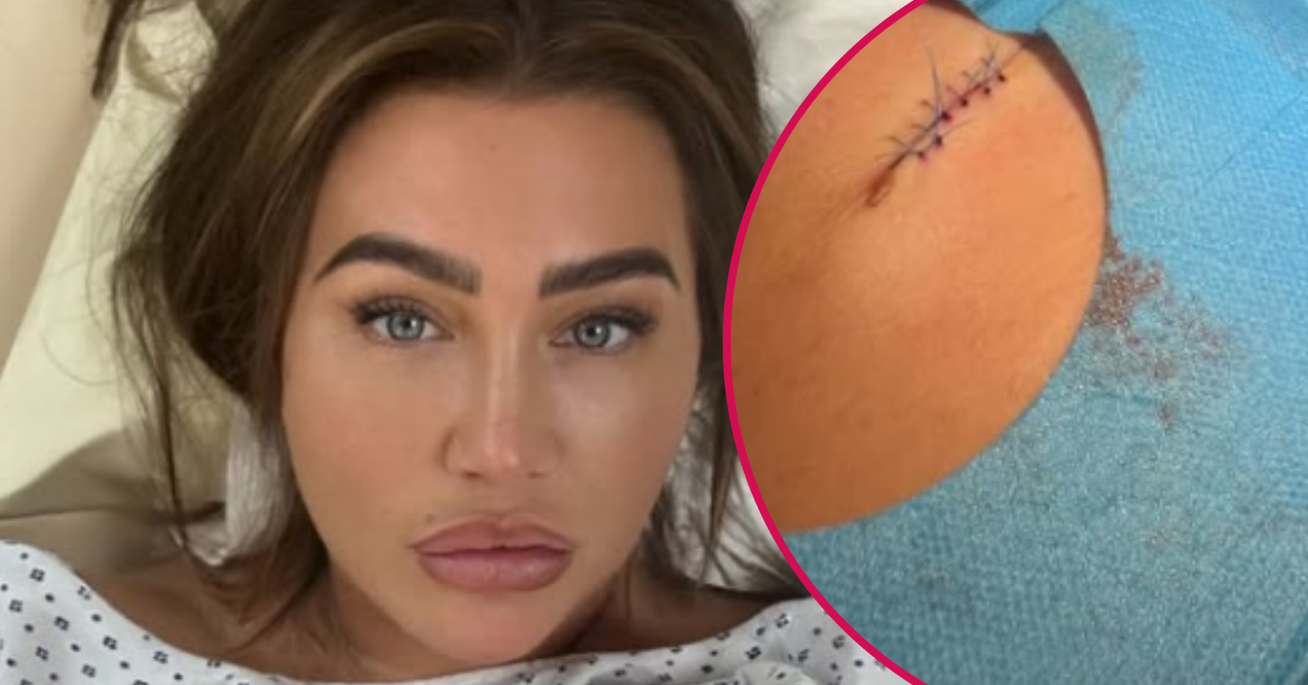 Lauren Goodger and stitches close up