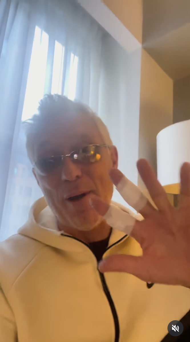 Martin Kemp on his Instagram showing his injury