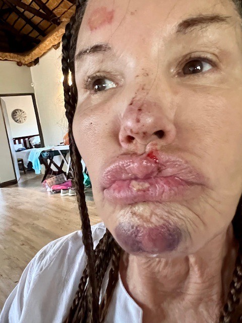 Janice Dickinson showing her injuries