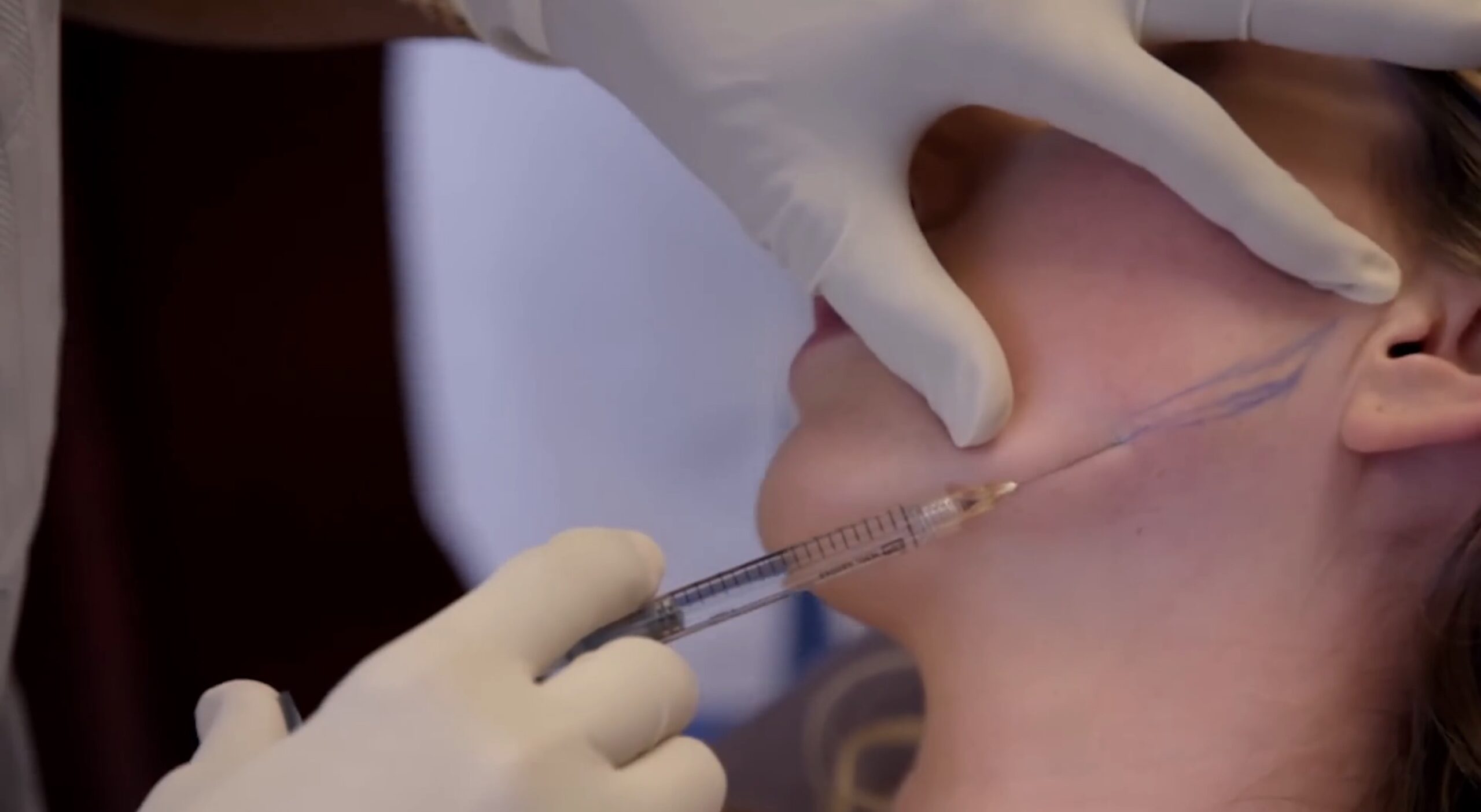 Katherine Ryan having jaw filler