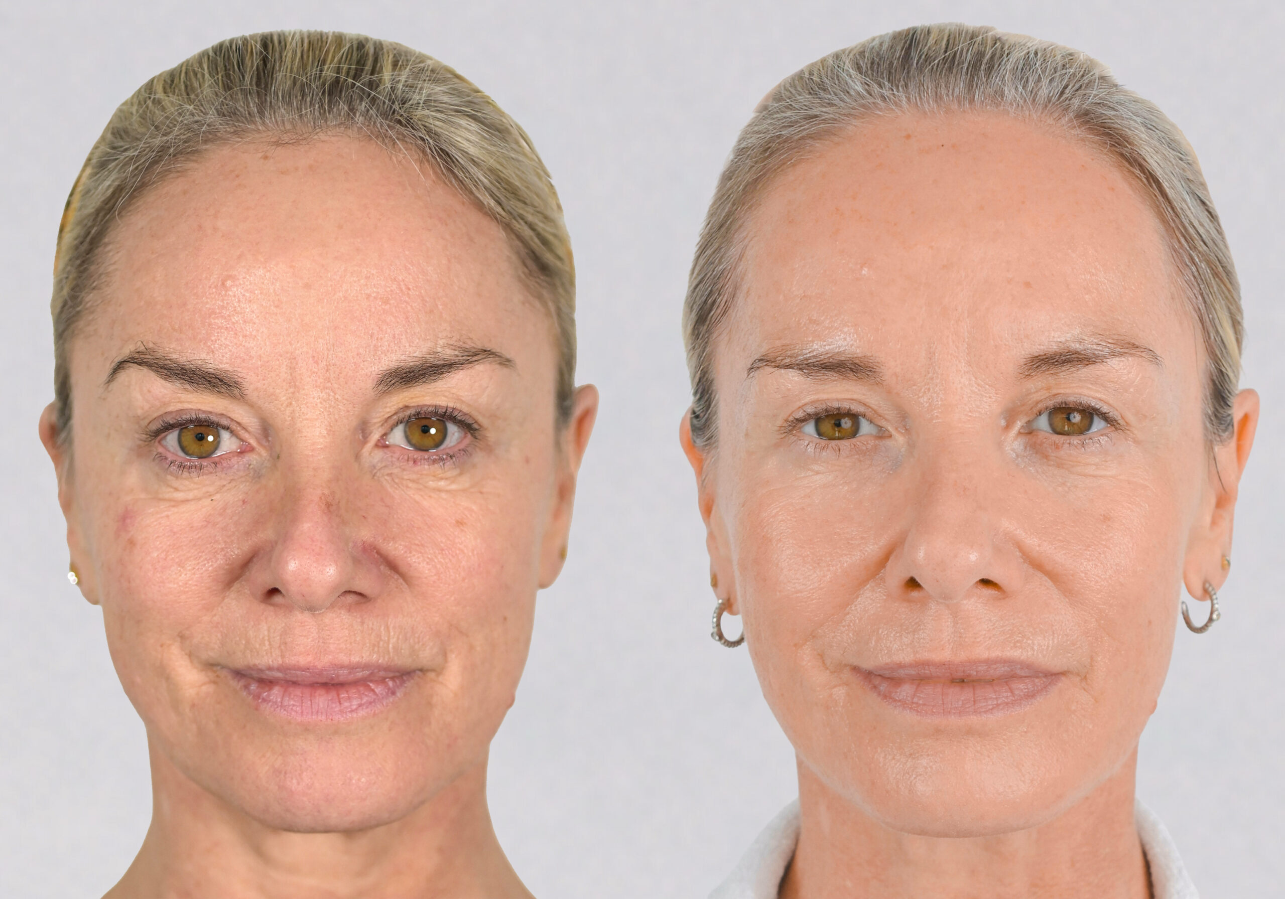 Tamzin Outhwaite before and after her facelift