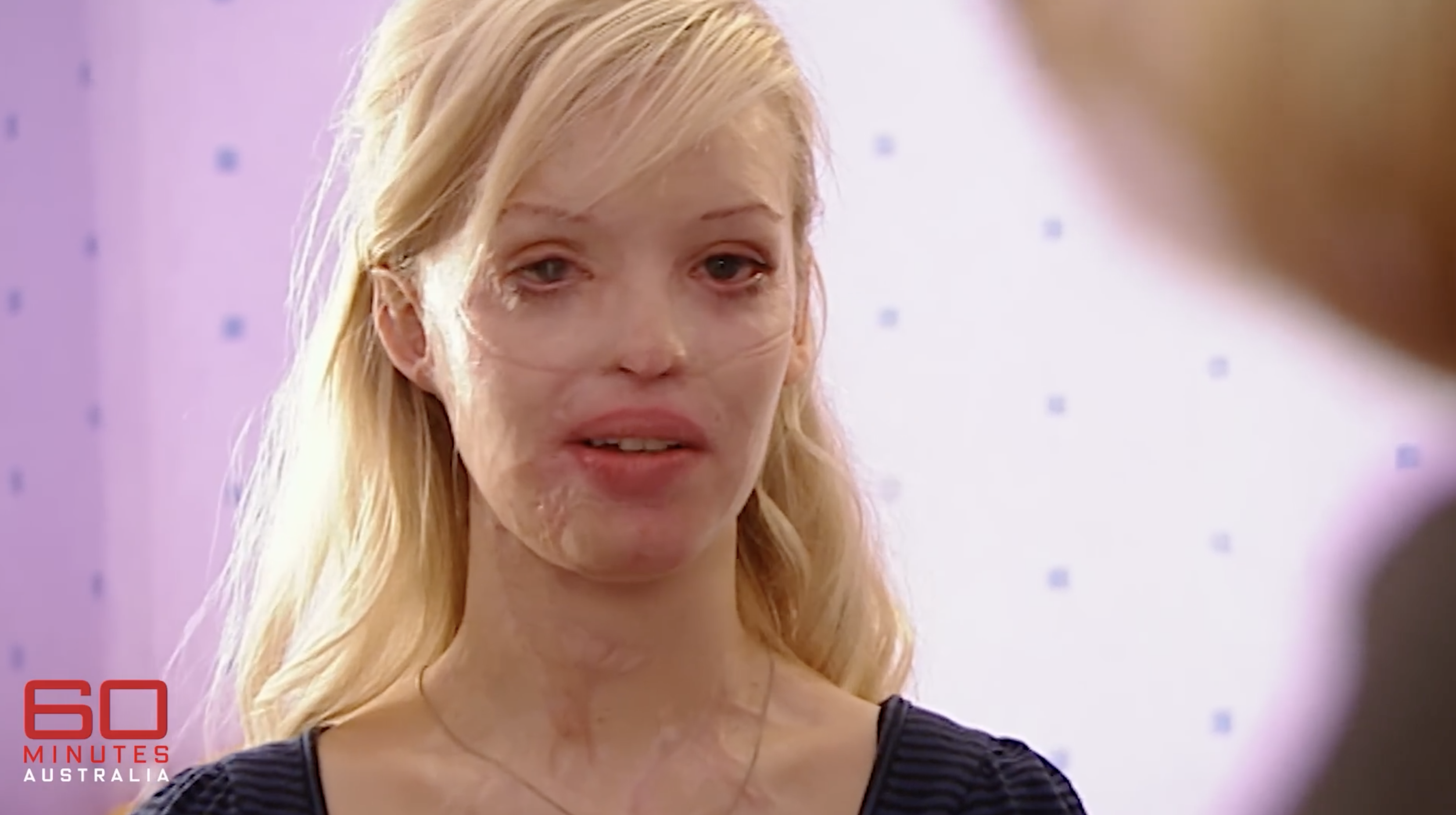Katie Piper on 60 Minutes Australia