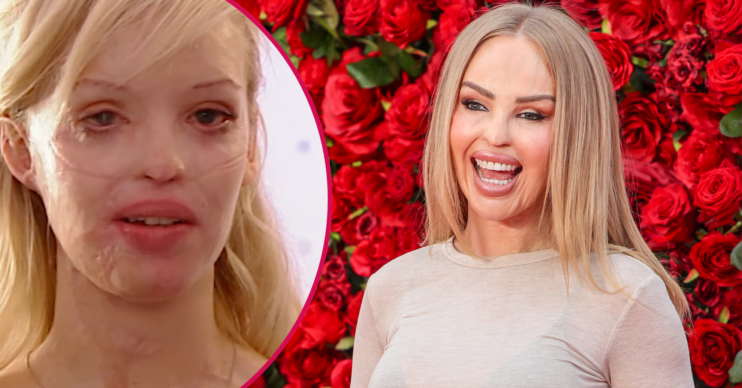 Katie Piper now and after the acid attack