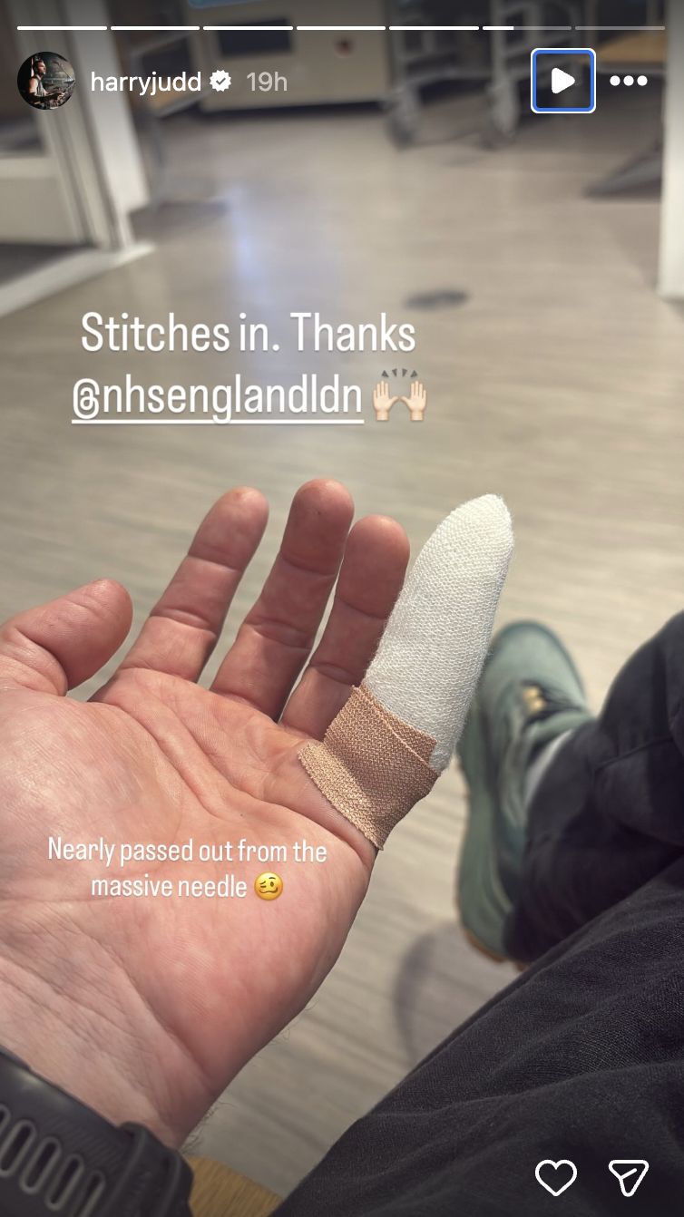 Harry Judd showing finger with stitches on Instagram story
