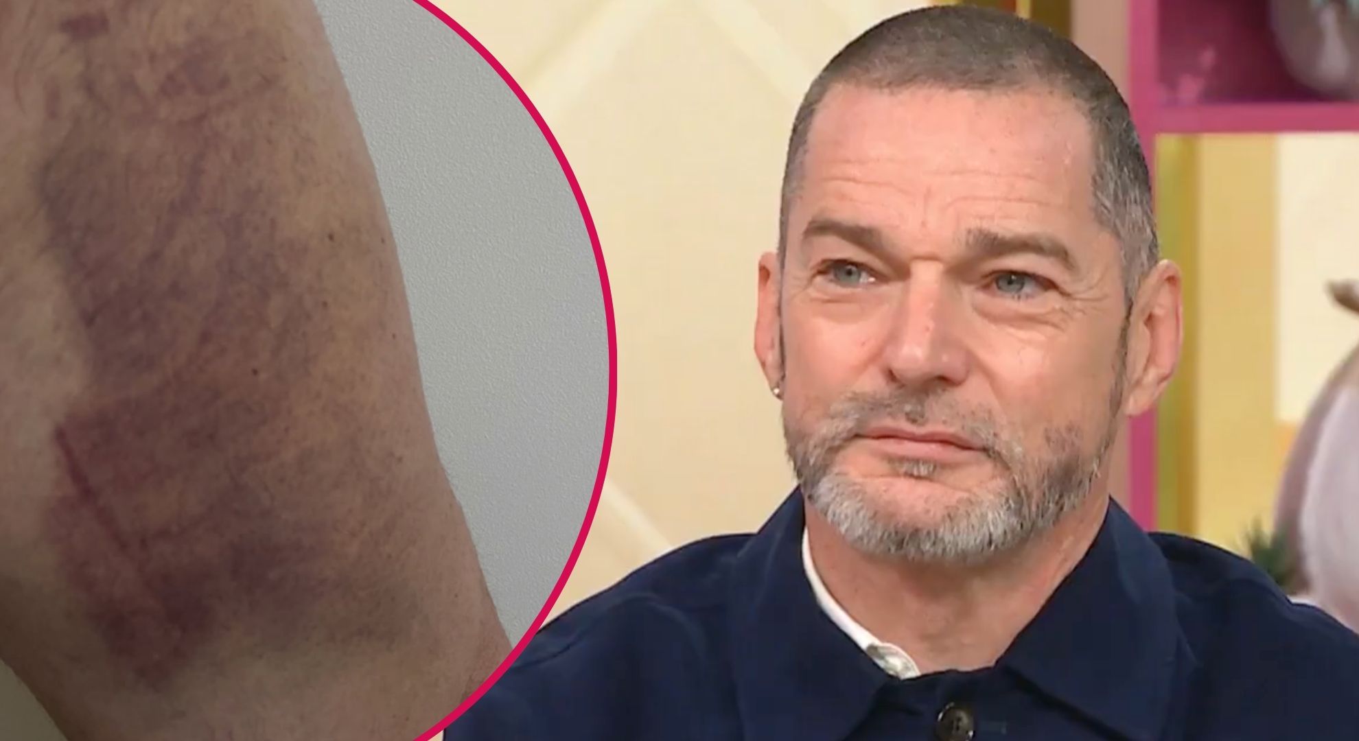 ‘What happened?!’ Fred Sirieix sparks concern as he’s pictured looking battered and bruised after freak accident