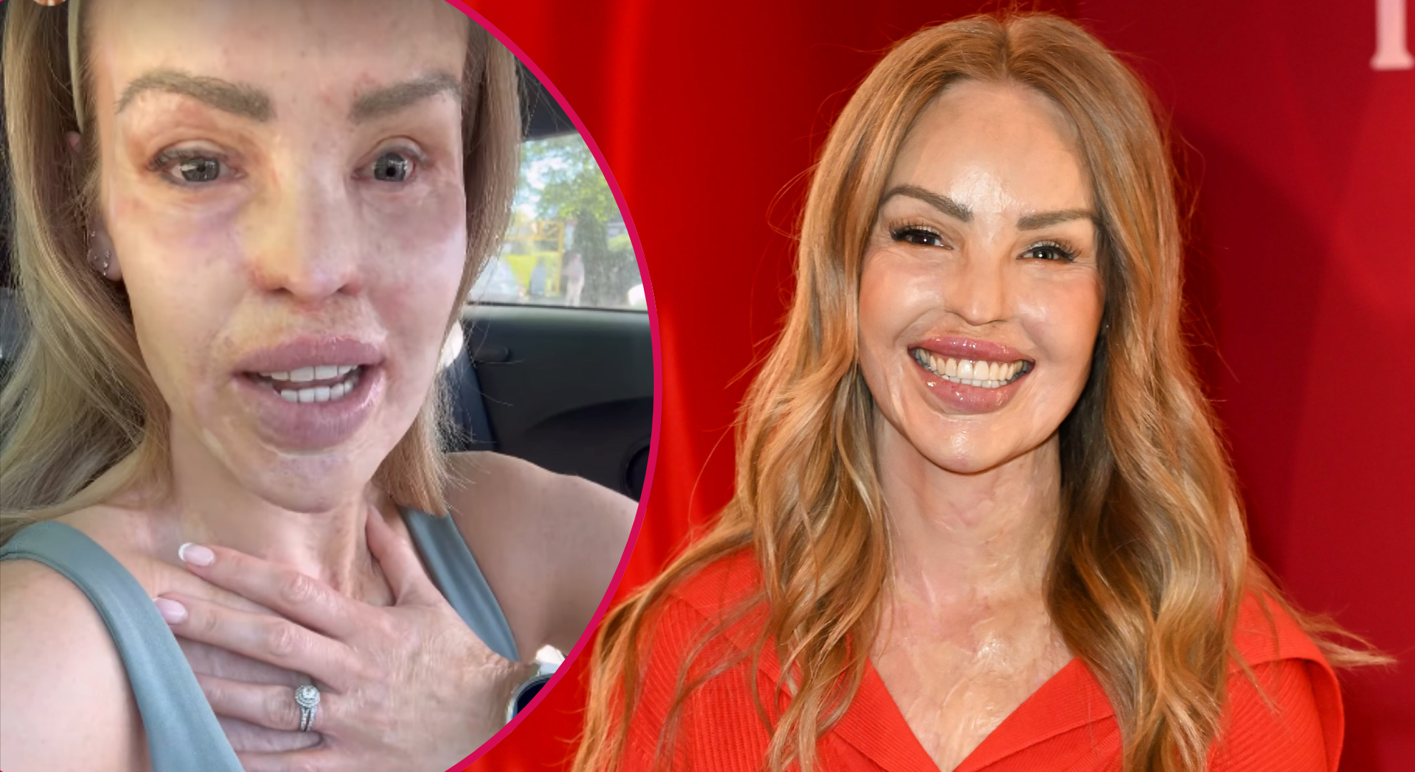 Katie Piper rushed to hospital by husband Richard after experiencing ‘severe pain’ in her eye