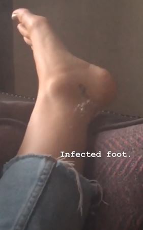 Lucy Fallon infected foot after British Soap Awards