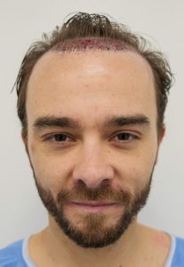 Jack P Shepherd undergoes hair transplant