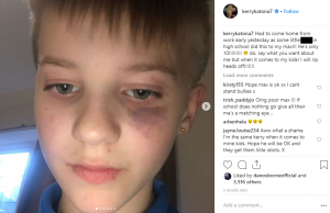 Kerry Katona's son gets beaten up