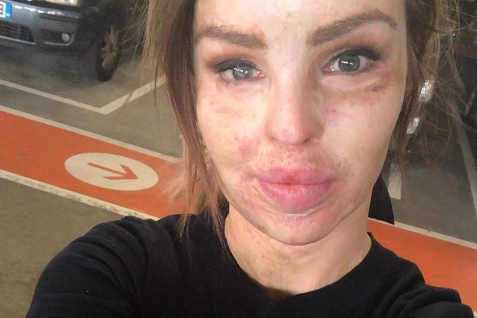 Katie Piper (Credit: Instagram @katiepiper_)